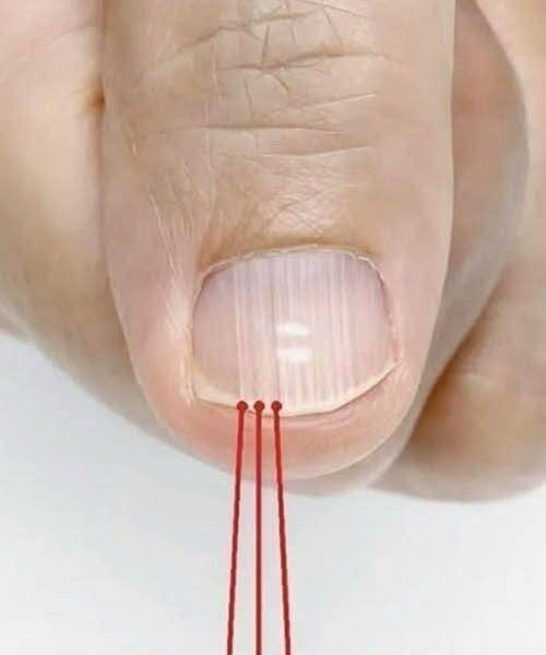 Vertical Nail Ridges After 40: Experts Say It’s Usually Normal but Worth Monitoring